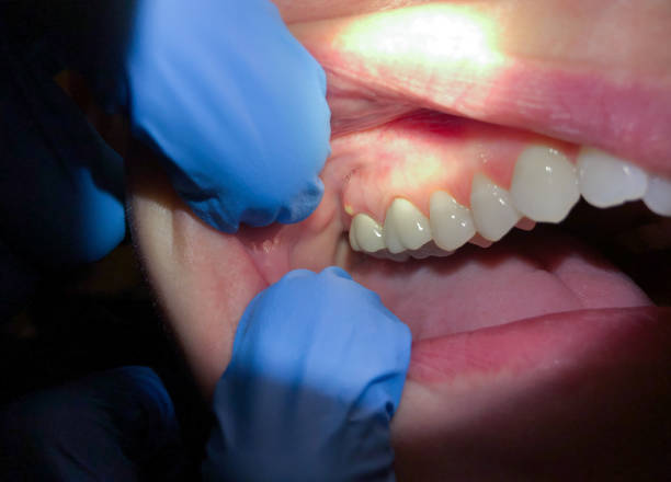 Teeth Whitening in KY